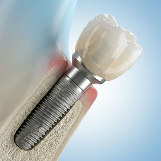 Dental Implants